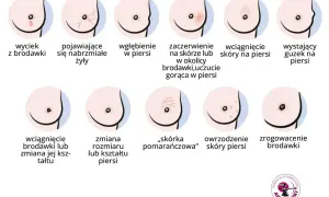 Ilustracja pokazuje objawy, które mogą oznaczać symbol choroby n63: wyciek z brodawki, wgłębienie, zaczerwienienie, guzek, zmiany skórne.