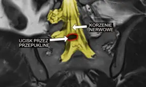 G54 - najpowszechniejsze objawy choroby korzeni i splotów nerwowych