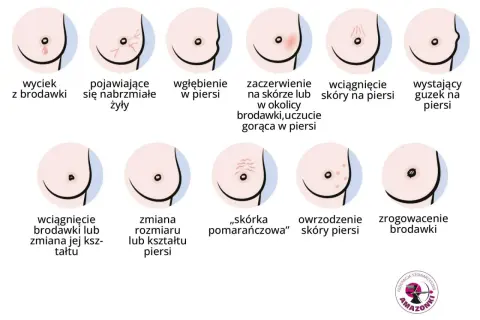 Ilustracja pokazuje objawy, które mogą oznaczać symbol choroby n63: wyciek z brodawki, wgłębienie, zaczerwienienie, guzek, zmiany skórne.