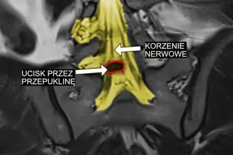 G54 - najpowszechniejsze objawy choroby korzeni i splotów nerwowych