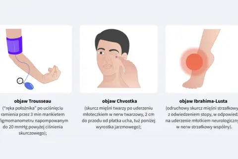 Ilustracja pokazuje objaw Chvostka: skurcz mięśni twarzy po lekkim uderzeniu w okolicę nerwu twarzowego.