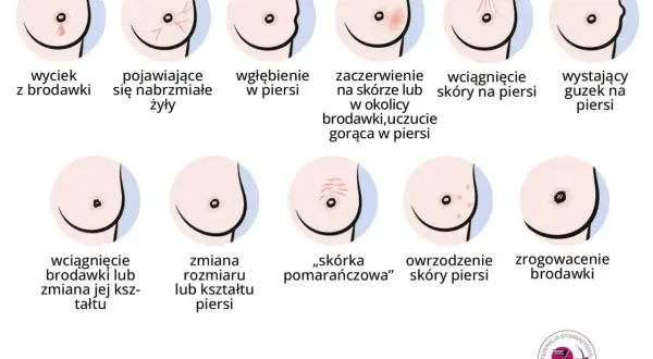 Ilustracja pokazuje objawy, które mogą oznaczać symbol choroby n63: wyciek z brodawki, wgłębienie, zaczerwienienie, guzek, zmiany skórne.