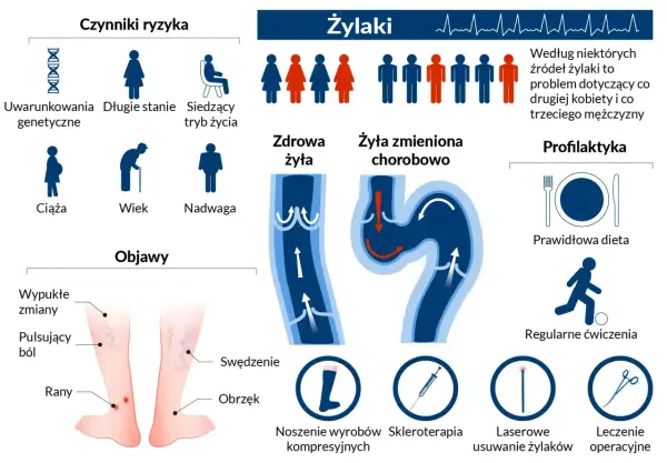 Ilustracja przedstawia żylaki, ich objawy, czynniki ryzyka (w tym uwarunkowania genetyczne) oraz metody leczenia, takie jak skleroterapia.