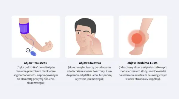Ilustracja pokazuje objaw Chvostka: skurcz mięśni twarzy po lekkim uderzeniu w okolicę nerwu twarzowego.
